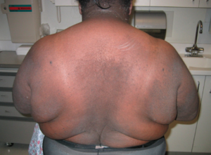 Acanthosis nigricans