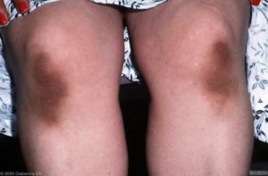 Acanthosis nigricans